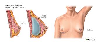 breast augmentation by implants